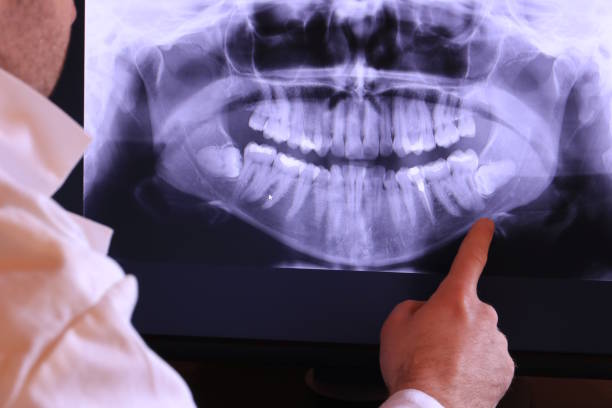 Best Knocked-Out Tooth (Avulsed Tooth) Treatment in Silver Summit, UT